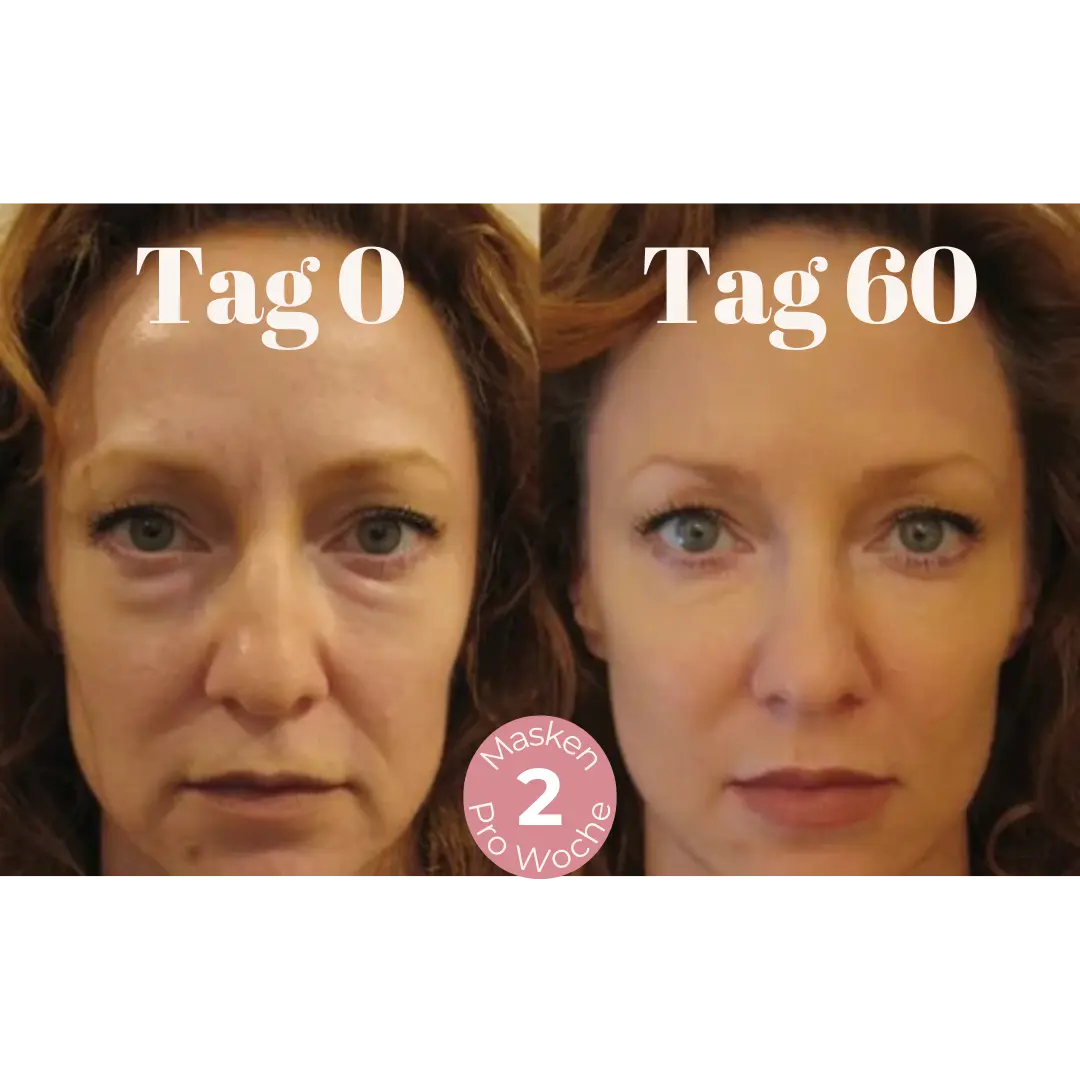 DermaLift™ – Nasolabialfalten Mikrokristalline Lifting Maske