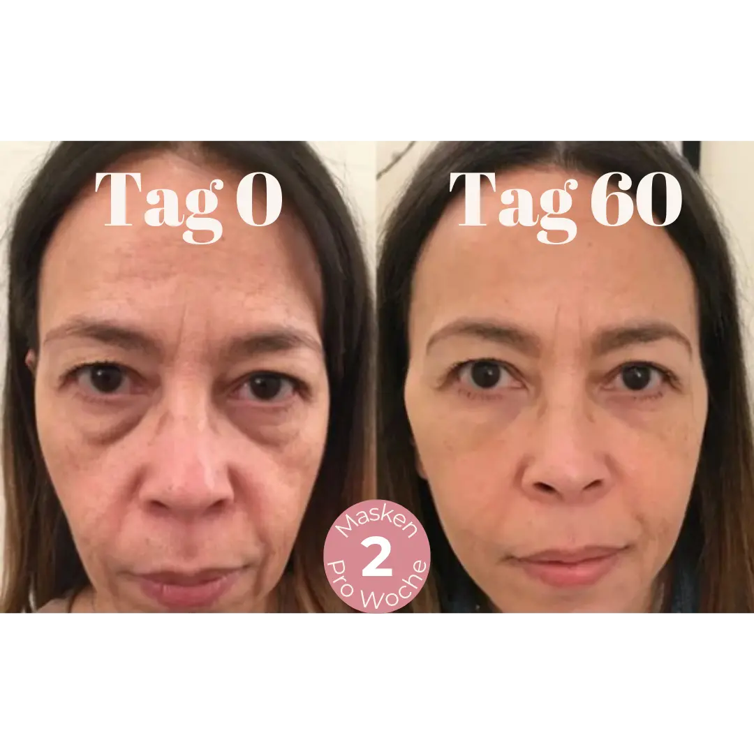 DermaLift™ – Nasolabialfalten Mikrokristalline Lifting Maske