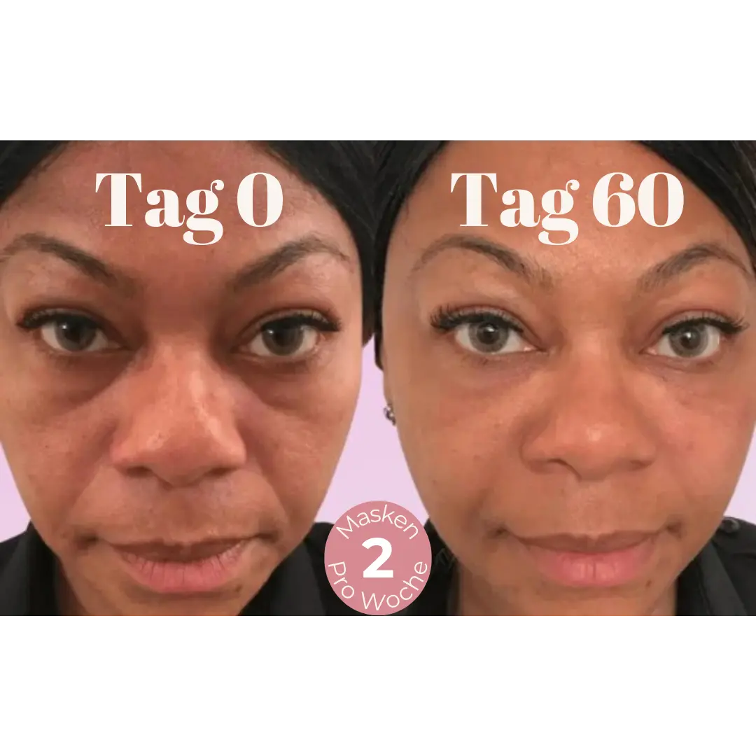 DermaLift™ – Nasolabialfalten Mikrokristalline Lifting Maske