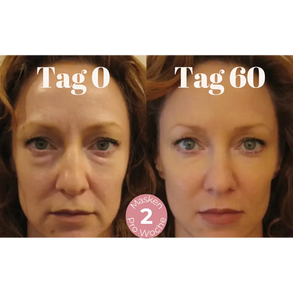 DermaLift™ – Nasolabialfalten Mikrokristalline Lifting Maske